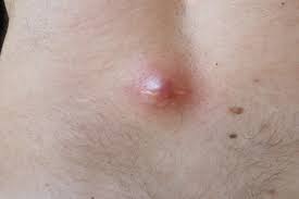 Image result for Pilonidal Cyst