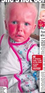 It's infant psoriasis.. she's not contagious'