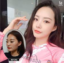 9 Months Change After Id Hospital Look How She Transformed In Id I Wish This Dramatic Result Happens To Me Rhinoplasty Beauty Clinic Plastic Surgery