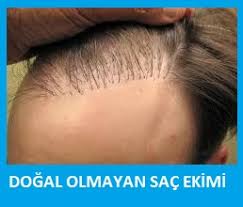 yanlis sac ekimi duzeltme operasyonlari sac ekimi destek