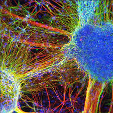 Schizophrenia is a serious mental illness that affects how a person thinks, feels, and behaves. Schizophrenia Symptoms And Treatment Live Science