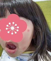 顔 ダニ 子供