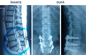 De aceea, daca oamenii au de ales intre o operatie clasica, deschisa si una minim invaziva, in care riscurile de infectie sunt aproape zero, o aleg pe cea din exista patru tipuri de tehnici minim invazive pe coloana vertebrala pe care cei doi medici neurochirurgi le efectueaza la centrul medical de. Interventie De Chirurgie Spinala Laborioasa