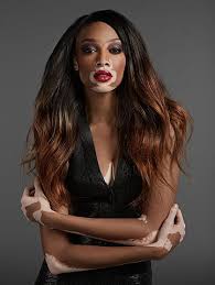 America S Next Top Model Chantelle Chantelle Brown Young Vitiligo Model Chantelle Brown
