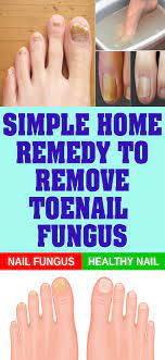 Simple Home Remedy To Remove Toenail Fungus Toenail Fungus Toenail Fungus Remedies Nail Fungus