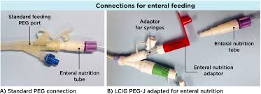 Enteral Feeding Using Levodopa Carbidopa Intestinal Gel Percutaneous Endoscopic Gastrostomy Tube Bernier 2017 Movement Disorders Clinical Practice Wiley Online Library