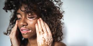 Image result for Vitiligo