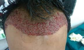 Pcos hair loss occurs as a direct result of hormonal imbalances. How To Regrow Hair With Pcos Regrow Hair