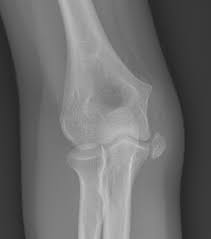 Medial epicondylar avulsion fractures are the most common avulsion injury of the. Https Posna Org Physician Education Study Guide Humerus Medial Epicondyle Fractures