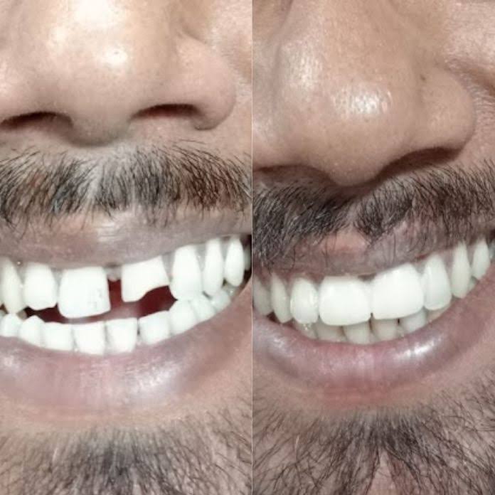 Cosmetic veeners and crowns.