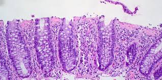Image result for Microscopic Colitis