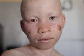 A medical mask provides protection to the person wearing the mask and prevents transmission to others. Edenpark Malawi Esther Ireland