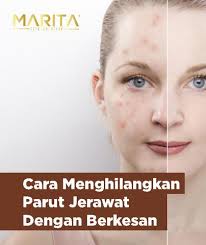Assalamualaikum.hi hari ni sy nak share cara nak hilangkan kesan parut akibat jerawat dan melicinkan kulit wajah.bahan yg korang kena ada.1. Cara Hilangkan Jerawat Dan Bekas Jerawat Menghilangkan Masalah