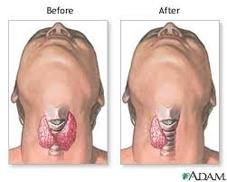 Pin On Thyroid Surgery