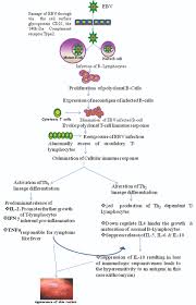 Amoxicillin rash is more common in children with girls being more likely to develop one than boys. Jcdr Azithromycin Infectious Mononucleosis Rash