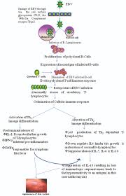 More than 65% of patients with mononucleosis experienced rash. Jcdr Azithromycin Infectious Mononucleosis Rash