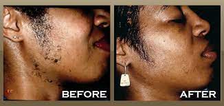 Laser Hair Removal Brentwood West Hollywood La Skineccable