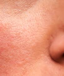 Rosacea can also affect broader areas of your cheeks, nose, chin, and forehead with each attack. Is Your Rosacea Worse During Covid Face Mask Effects