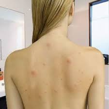 Causes And Treatments Of Back Acne Chest Acne Etc Cicatrices Acne Sante Et Beaute Sante Beaute