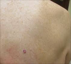 Sometimes the skin on the top of the tumor breaks open and bleeds. Complete Remission Of Metastatic Merkel Cell Carcinoma In A Patient With Severe Psoriasis Mdedge Dermatology