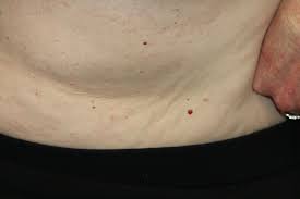 What are the clinical features of cherry angioma? Cherry Hemangioma Article
