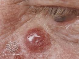 Image result for Merkel Cell Carcinoma