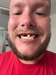 Has anyone got ￼ dentures what was you A1C if so and how was healing ￼