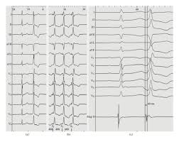 Image result for Extrasystole