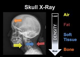 Neuroimaging X Ray Ct Scan And Mri Flashcards Quizlet