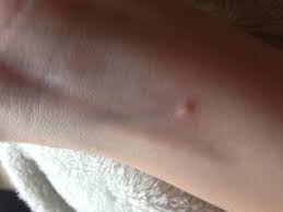 Kleine Blaschen An Der Haut Allergie Juckreiz Ausschlag