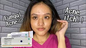 Vaginal yeast infections before a period are common due to changes in hormones around the menstrual cycle. I Tried To Use Ketoconazole Cream For My Small Acne English 66 Youtube