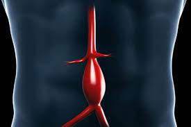 Os sintomas de um aneurisma da aorta abdominal podem parecer com outras condições ou problemas médicos. Aneurisma De Aorta Abdominal Amato