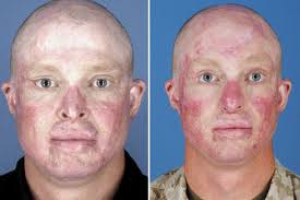 Recovery for Bomb Survivor Involves Family, Helping Others