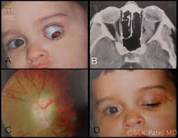 Optic Nerve Glioma