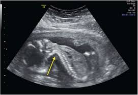 Image result for Breech Presentation
