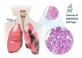 If you have been diagnosed with adenocarcinoma cancer, you have a cancer that developed in one of the glands that lines the inside of your organs. Pleural Mesothelioma Stages Treatment Prognosis