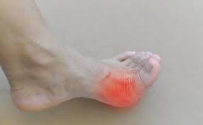 Pergelangan kaki sakit saat bangun tidur, apakah pertanda asam urat? 10 Ciri Dan Gejala Asam Urat Agar Tidak Sampai Tinggi