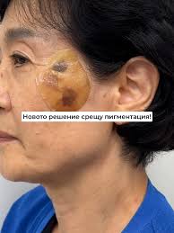 Бръчки и ботокс: Как да се справим с тях