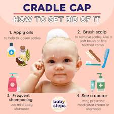 Image result for Cradle Cap