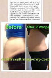 This Mommy Had A Csection Just Like Me She No Longer Wants A Tummy Tuck Those Diy Fake Wraps Ain T Got Nothin Tummy Tucks Skin Tightening Stomach Saggy Skin
