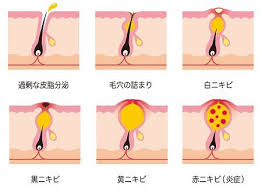 顎 あご ニキビの原因はアノ食品 改善策や跡を残さない方法も紹介 ニキビ 筋肉 落とす ニキビ あご