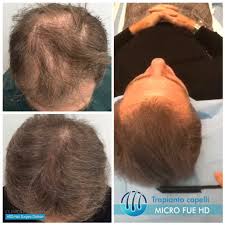 Scopri come funziona un trapianto di capelli senza cicatrici e rasatura. Trapianto Capelli Su Diradamento Severo Uomo Video Clinica Pallaoro