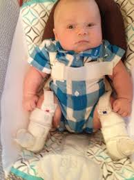 The Pavlik Harness Hip Dysplasia Baby Baby Onesies Hip Displasia