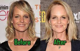 Hunt hasn't admitted to booking any plastic surgery, but viewers of her miniseries world on fire were convinced she had, and that her new look . Helen Hunt Plastic Surgery Facelift Fillers Before And After Photos Lights Fashion Beauty