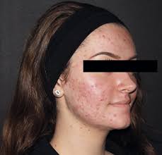 HOW I DO IT Approaches to acne treatment: Pulsed-dye laser