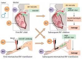 Image result for Rh Sensitization
