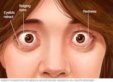 Image result for what is the treatment for graves disease