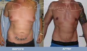 Breast reduction at spire liverpool hospital. Male Breast Reduction Costs Are Lower Than Ever Dr Dana Md