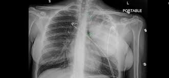 Image result for Lung Abscess