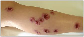 Multilesional cutaneous leishmaniasis | CMAJ